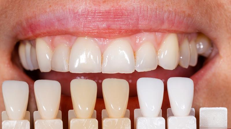 Veneers Belleville, IL